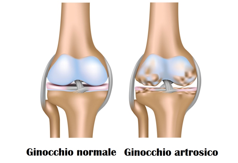 infiltrazioni-acido-ialuronico-ginocchio-cura infiltrazioni-acido-ialuronico-ginocchio-cura